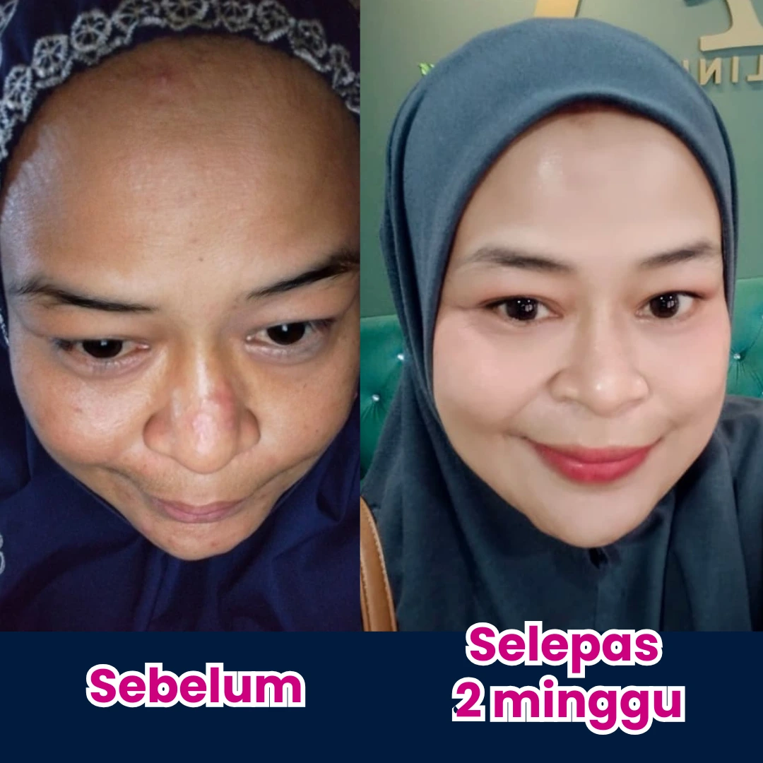Before dan after Zue Zainal 47 tahun